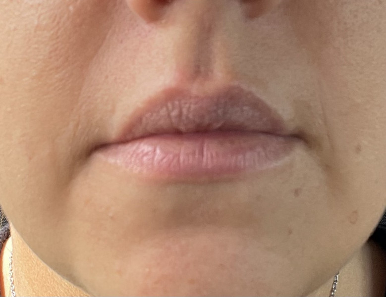 Anyone had a lip enhancement? Yes or No? Photo included :-)