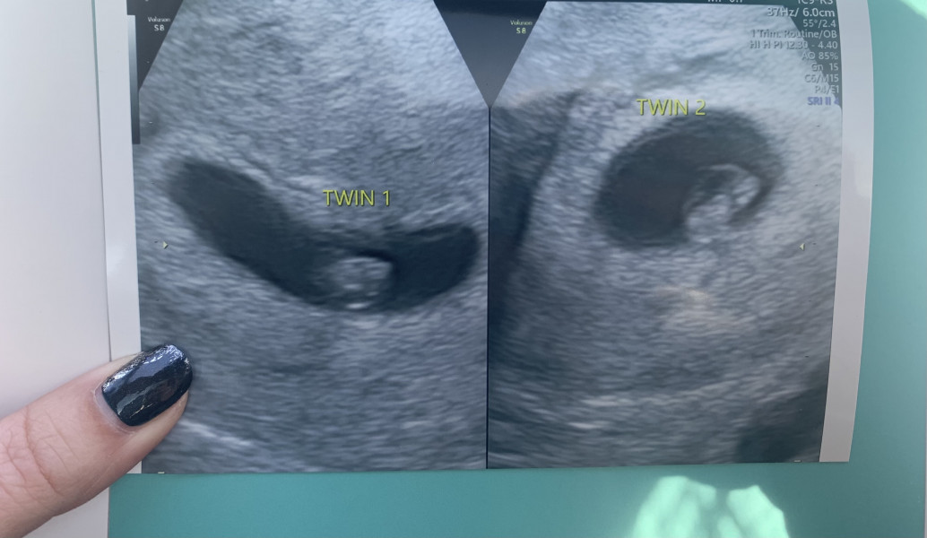 Twin pregnancy