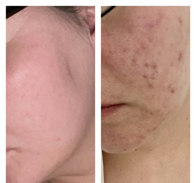 To want clear skin? 