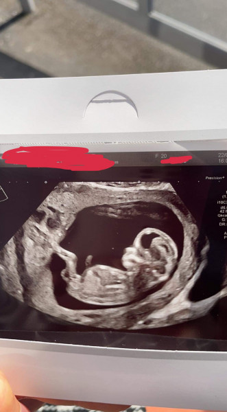12 weeks - can you tell gender?