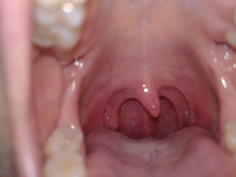 Tonsil stone/abscess?!