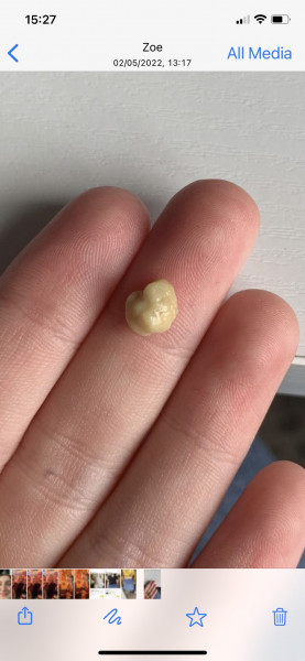 My daughter's tonsil stone