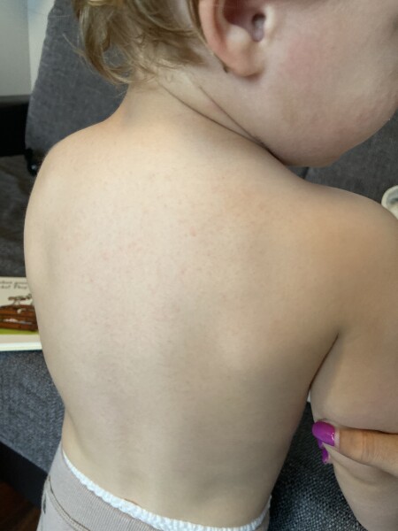 Scarlet fever 