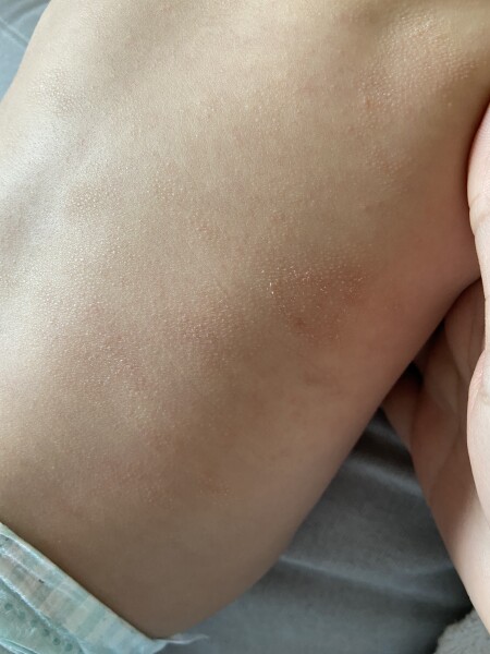 Strange rash on 8 month old’s back 
