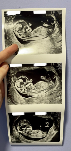 Navigating pregnancy after loss thread 3