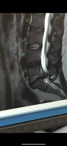 Spinal Fracture - Second Opinion - Medical Advice