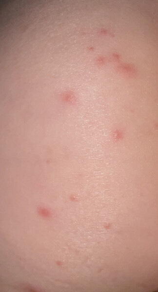 Pimples on toddlers privates what could this be?