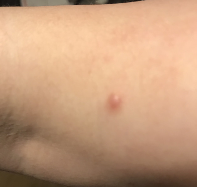 Do I need this lump looked at?