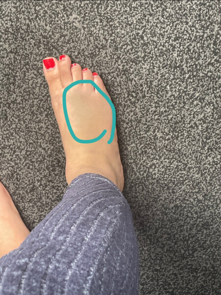 AIBU to think that this is just a sprain?