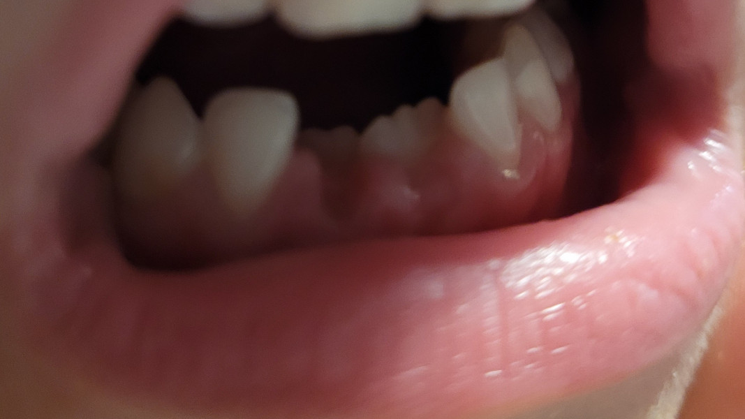Childs adult bottom teeth look too far back -with pictures 