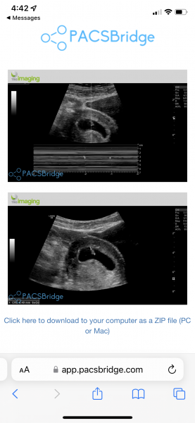 6 weeks 2 day’s HCG drop