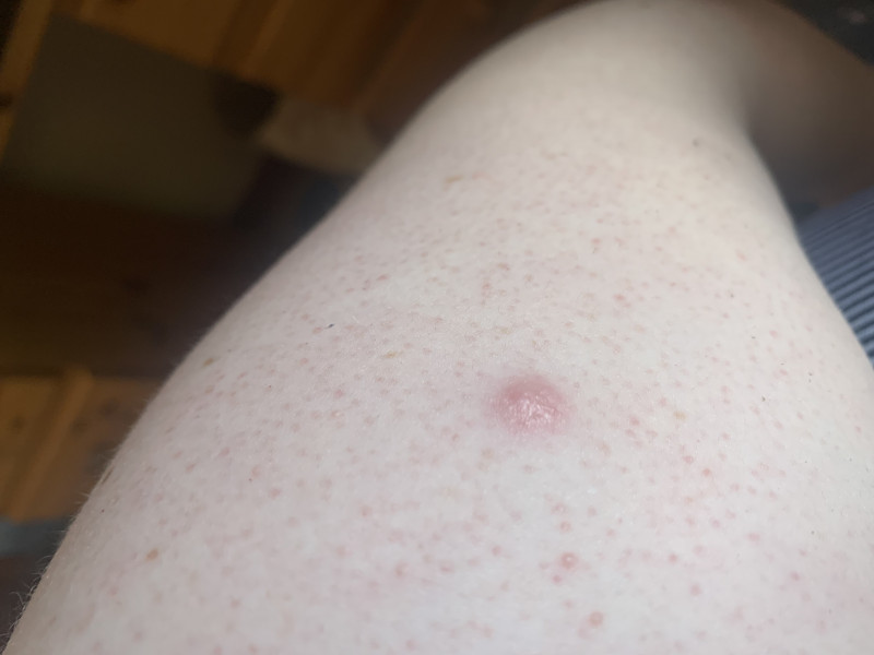 Do I need this lump looked at?