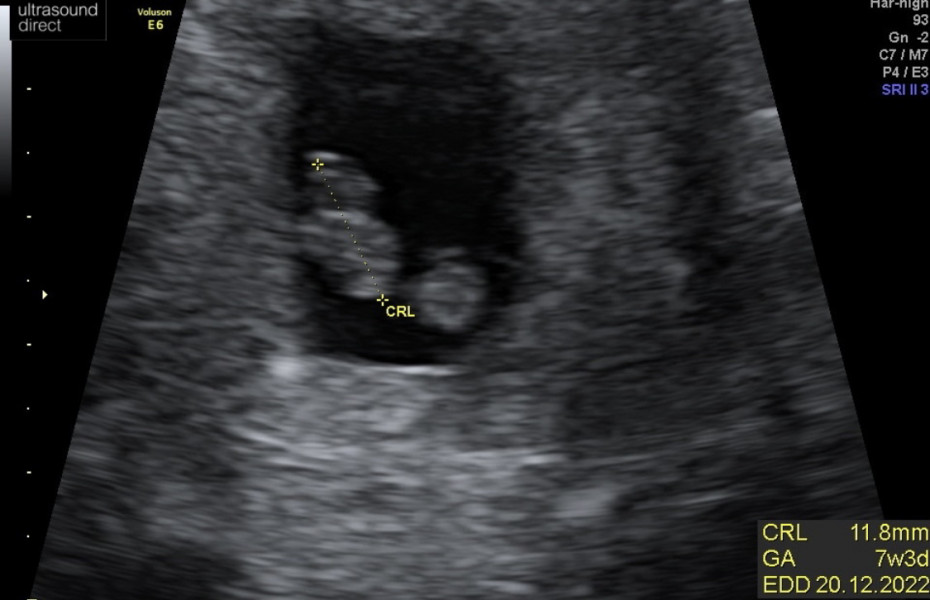 Navigating pregnancy after loss thread 2