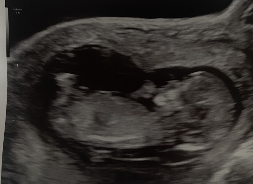 Nuchal Translucency Scan