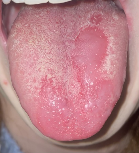 PLEASE help- something weird happening with my tongue