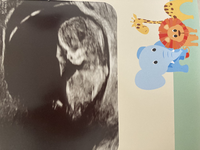 BFPs following IVF to take symptoms & scans