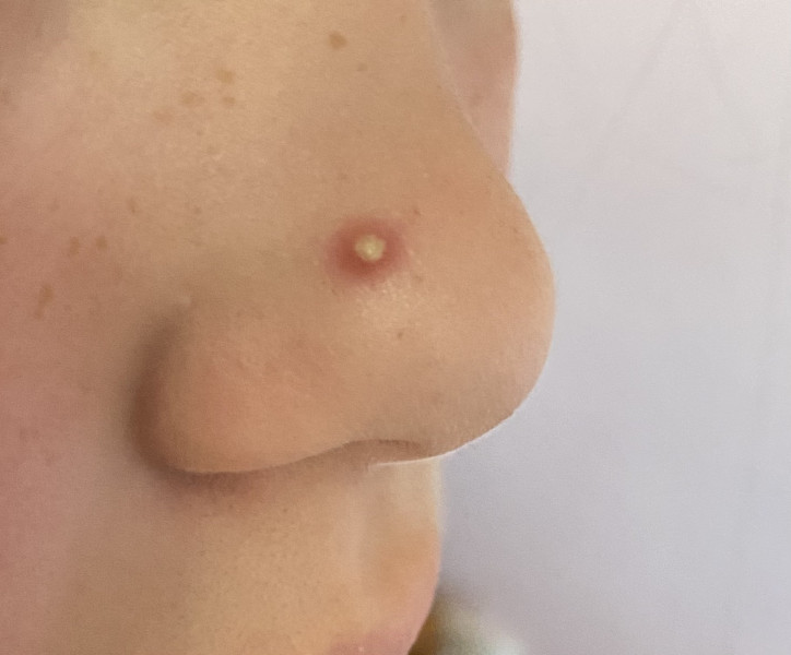 Child has her first spot...