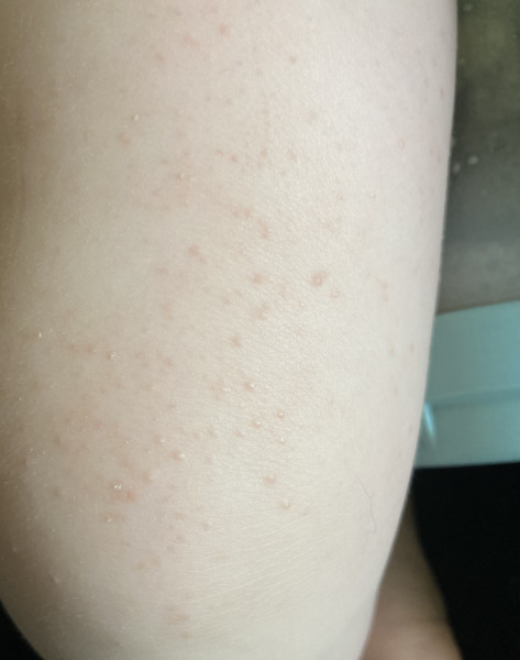 Rash/spots on 10 month old?