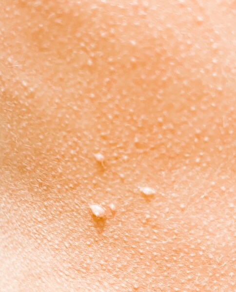 Any idea what these are? Not chicken pox.