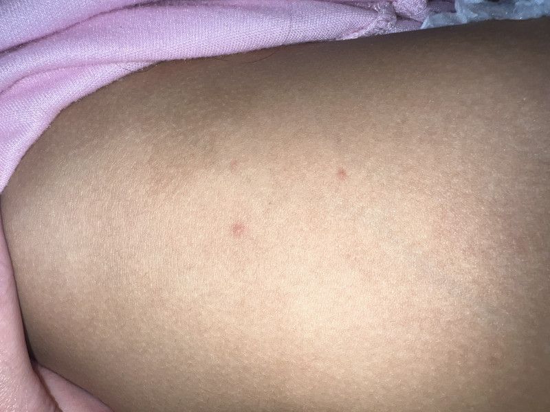 Apologises if not the right place… but are these likely to be chicken pox?