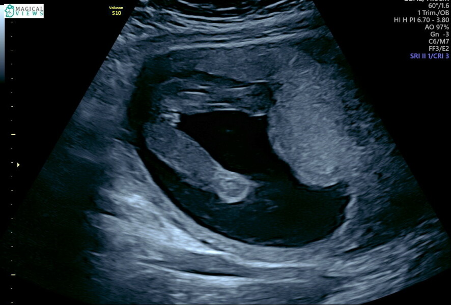 Gender - scan photo 
