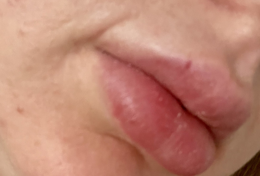 Red spot on lip that won't go away - any ideas?
