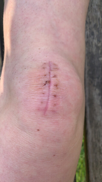 Bursitis of elbow