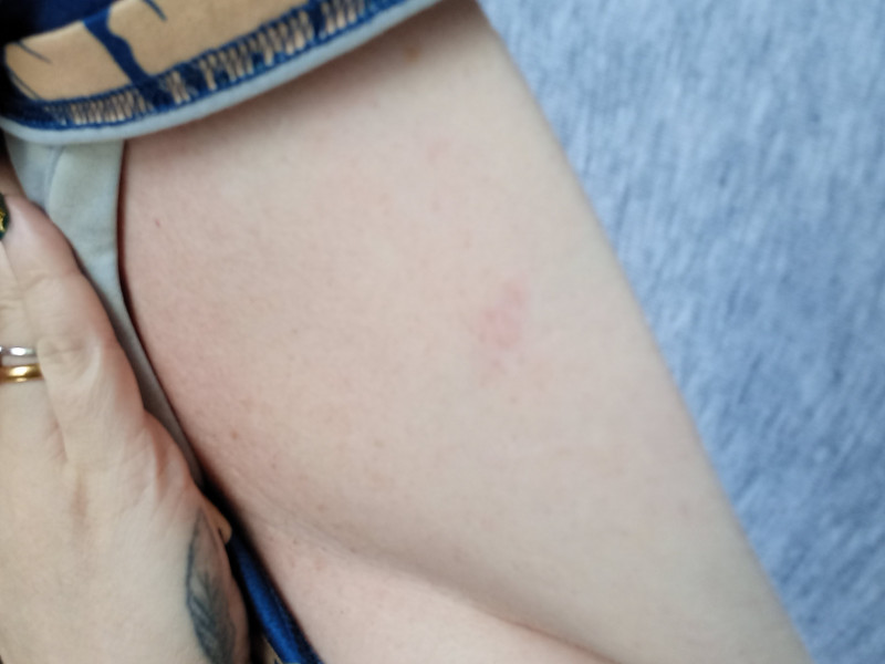 Strange patch of skin appeared on boob!