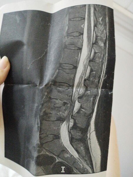 Spinal Fracture - Second Opinion - Medical Advice