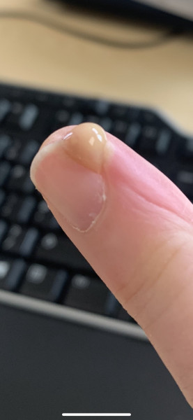 Infected nail finally burst!!!