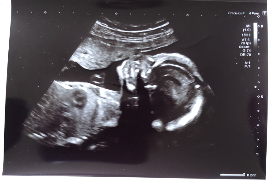 Navigating pregnancy after loss thread 3