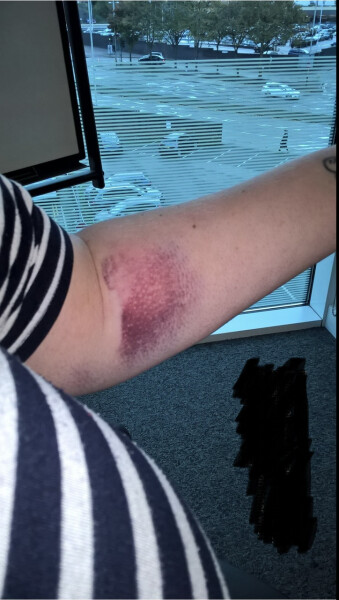 Pain/bruising after anaesthetic canula - is this normal?