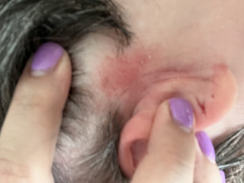 Patch test 