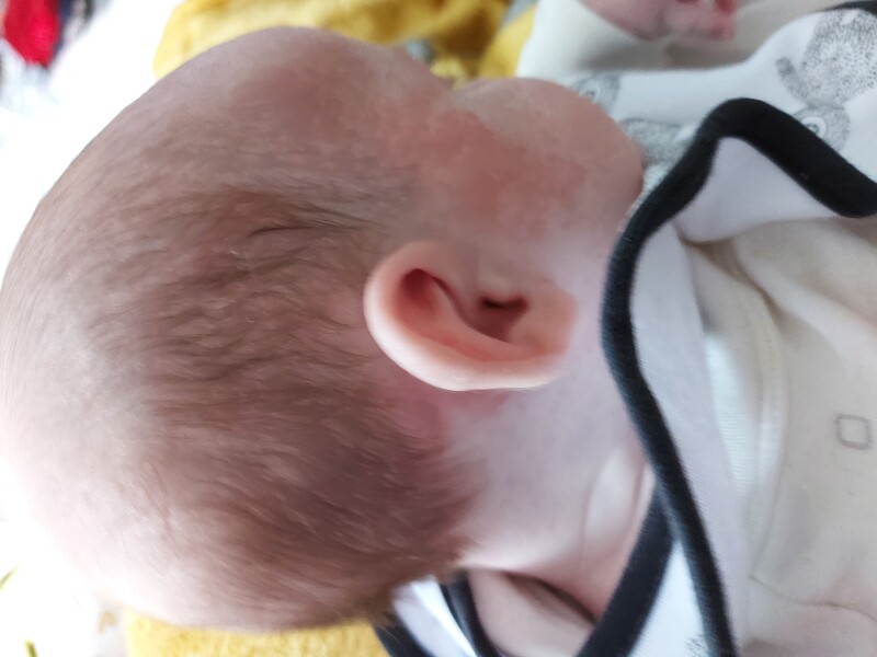 Best cream for eczema?