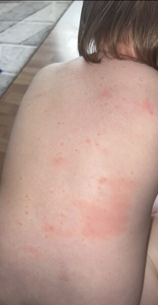 Chicken pox?