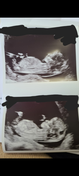 Nub theory/ gender guesses? 12+5