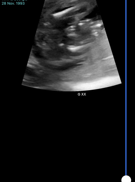 Advice please, Anatomy scan Boy or girl? Should I do a gender scan too? 
