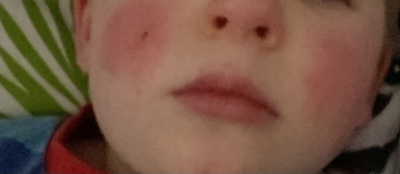 Toddler red cheeks no temp