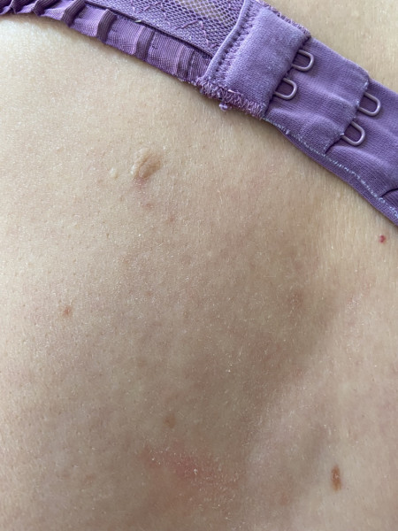 Would you be worried about this mole ?