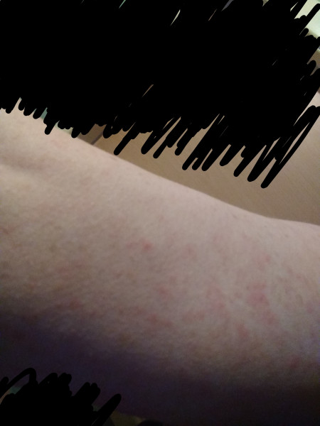 Ok so this is a rash. What kind of a rash is it tho 