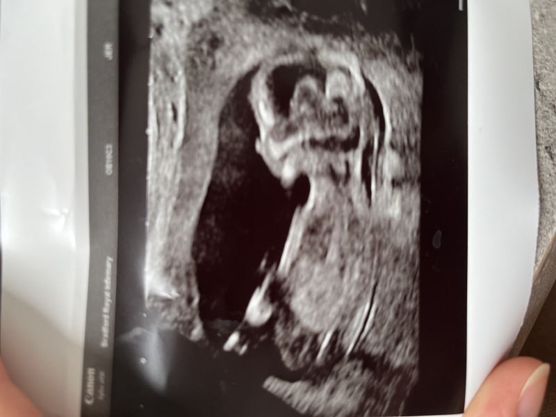 13 weeks scan, guess gender?