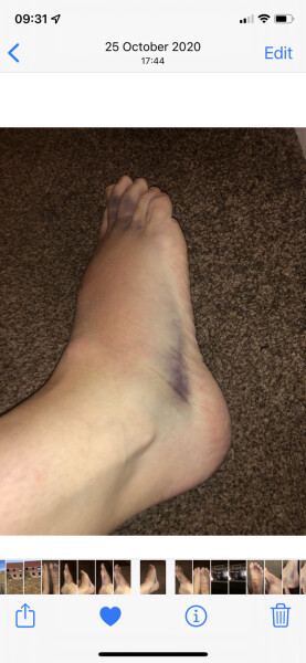 Foot going blue, what's going on?