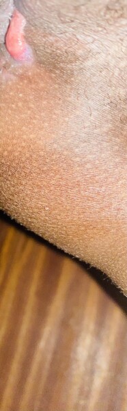 Episiotomy help!  **Content warning**