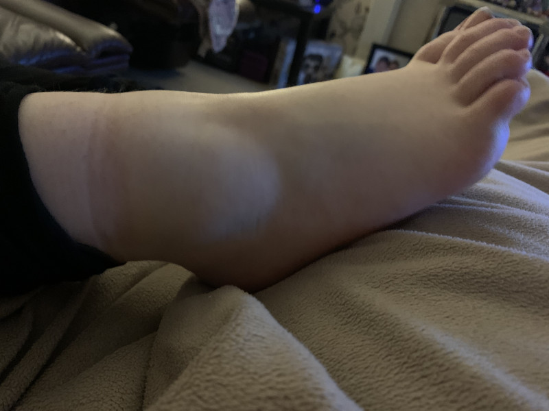AIBU to think that this is just a sprain?