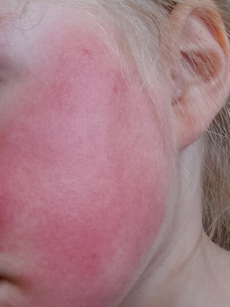Horrific rash on face at nursery only