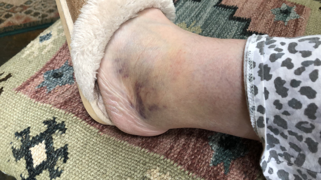 AIBU to think that this is just a sprain?