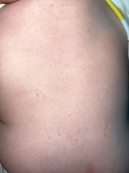 Chicken pox or viral infection?