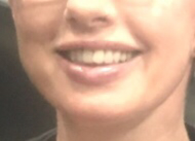 Anyone had a lip enhancement? Yes or No? Photo included :-)