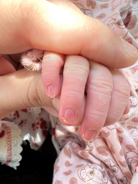Newborns finger red and swollen?