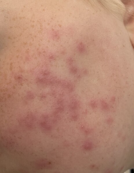 Acne? (Photo included, sorry)